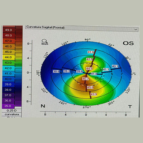 Topografía corneal
